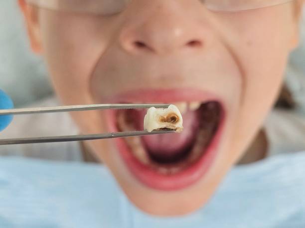 Best Emergency Dentist for Lost Fillings or Crowns in Nevada, IA